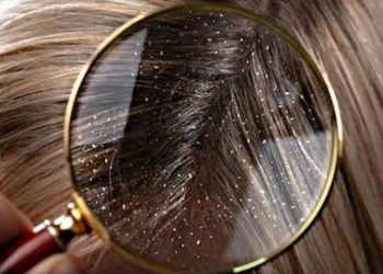 إزالة القشرة من الشعر من أول استخدام