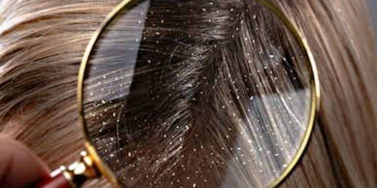 إزالة القشرة من الشعر من أول استخدام